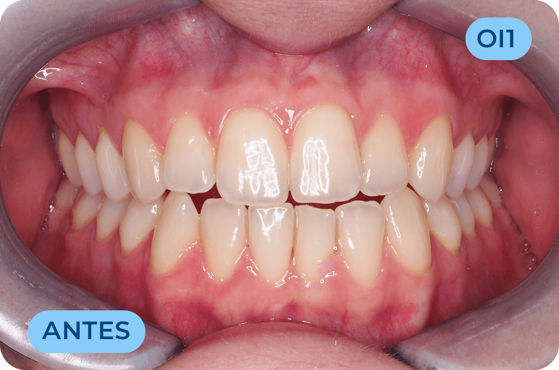 Ortodontia Invisivel