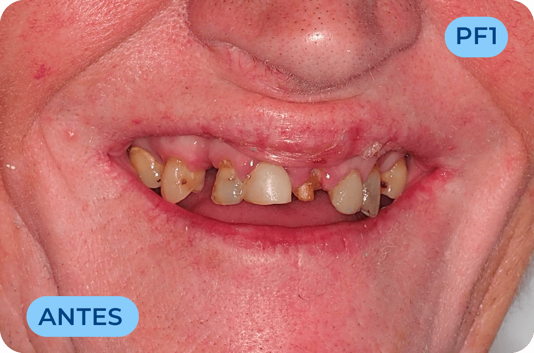 Protese Total Fixa Com Implantes