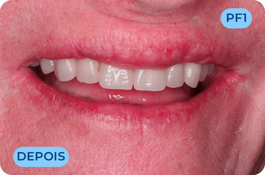 Protese Total Fixa Com Implantes