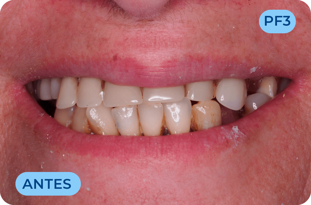 Protese Total Fixa Com Implantes