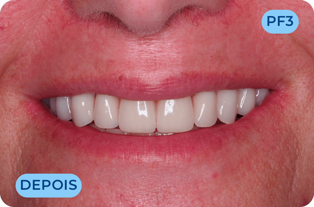 Protese Total Fixa Com Implantes